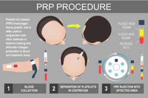 prp موی سر